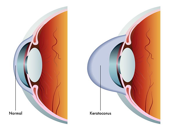 Keratoconus Optometrist in Bellefonte