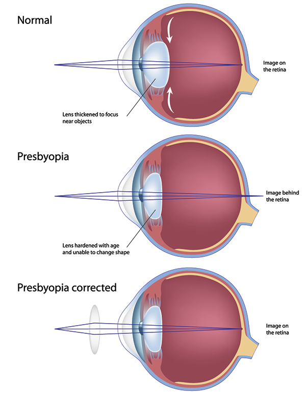 Presbyopia Eye Care in Bellefonte